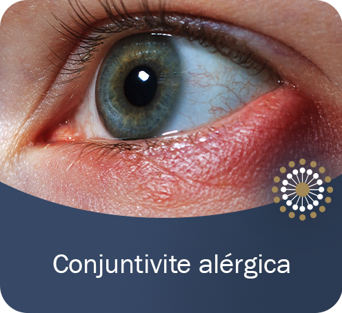 Conjuntivite alérgica