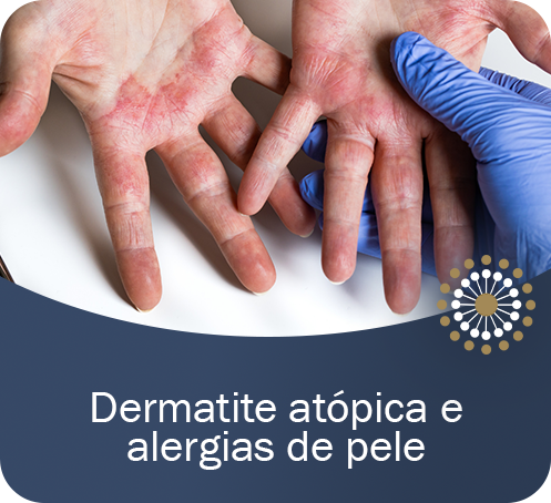 Dermatite atópica e alergias de pele