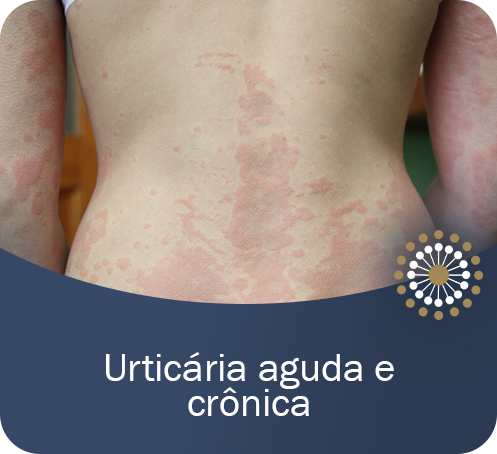 Urticária aguda e crônica